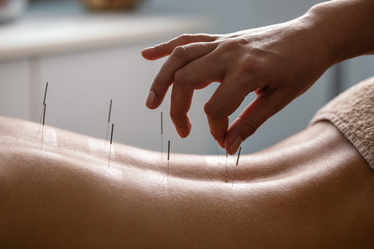 Palawan Acupuncture Healing